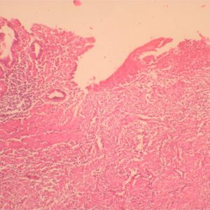 Stomach Non neoplastic