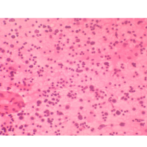Hashimotos Thyroiditis