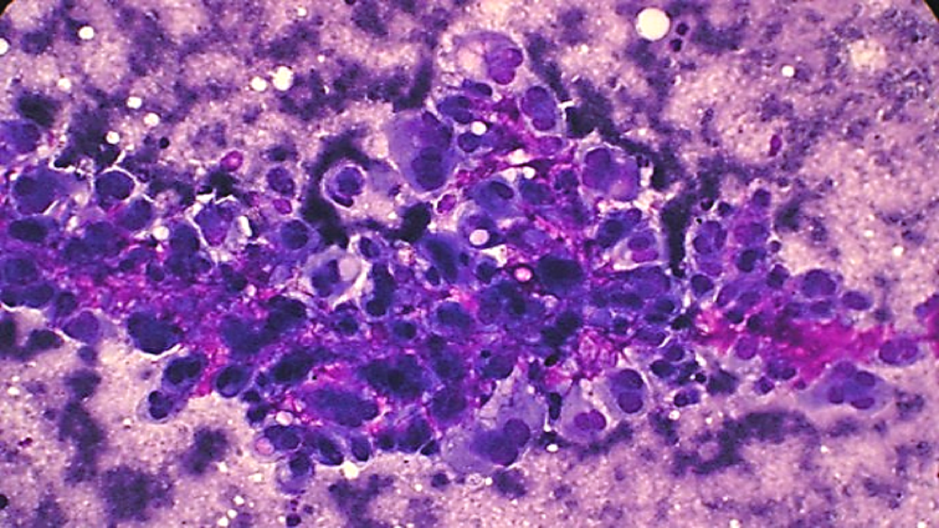 Bone Cyto 8 and 9 : Ewing’s sarcoma; Plasma Cell Myeloma