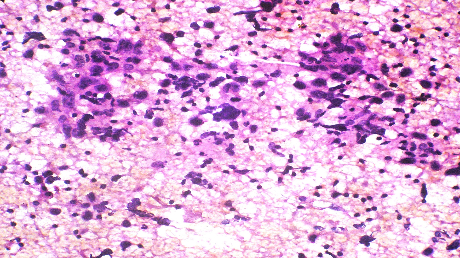 Breast CY Case 1 : Fibroadenoma and phyllodes tumour